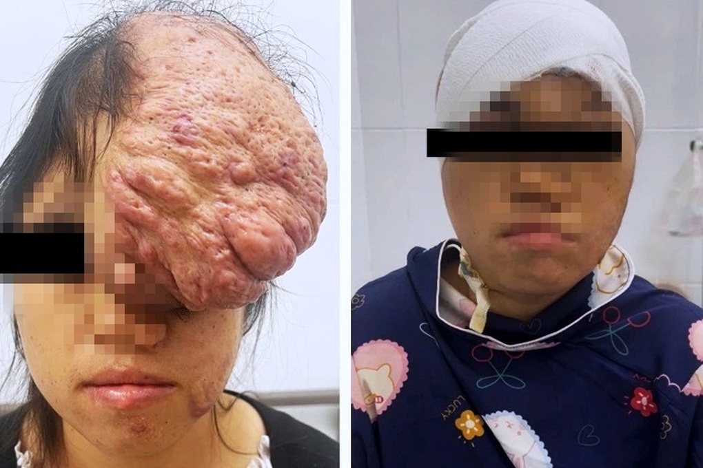 HCMC: Dringende Rettung von 2 Frauen mit bösartigen Tumoren im Darm und Schädel - 3 TPHCM: Khẩn cứu 2 phụ nữ mang khối u quái ác ở ruột, xương sọ - 3