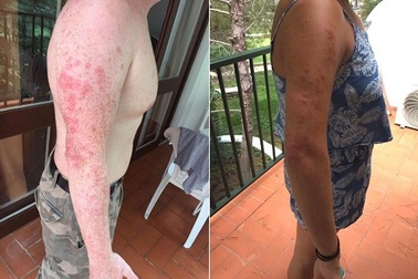 Du khách ám ảnh khi thuê nhầm phòng bị cả trăm con rệp hút máu tấn công