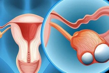 U nang buồng trứng có nguy hiểm?