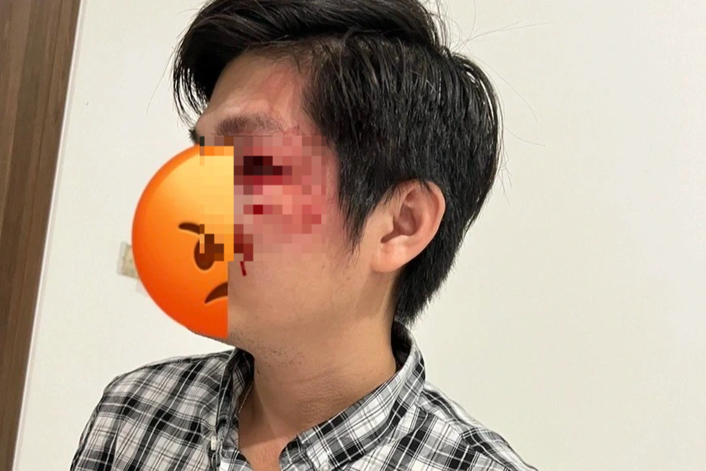 Vụ chủ chó đánh người đàn ông bảo vệ con: Nạn nhân quyết không hòa giải - 1 Vụ chủ chó đánh người đàn ông bảo vệ con: Nạn nhân quyết không hòa giải - 1
