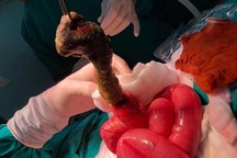 Mắc hội chứng “công chúa tóc mây” bé 6 tuổi tắc ruột