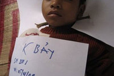 Bé trai 8 tuổi bị cành cây xuyên qua cổ 