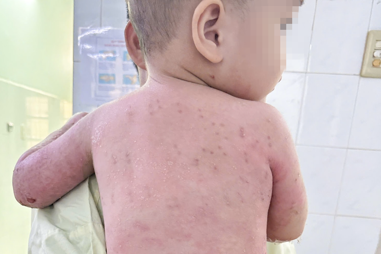 Bé trai 2 tuổi bỏng 60% cơ thể thương tâm, mẹ ruột hiến da cứu con - 3