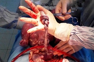 Dây rốn thắt nút 2 vòng, bé sơ sinh may mắn sống sót