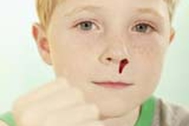 Chảy máu cam - Không thể chủ quan