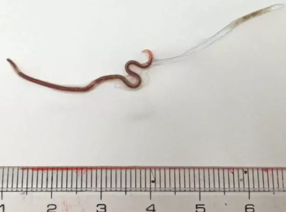 Rùng mình bác sĩ gắp giun 3,8 cm ra khỏi miệng người phụ nữ ăn cá sống - 3 Rùng mình bác sĩ gắp giun 3,8 cm ra khỏi miệng người phụ nữ ăn cá sống - 3