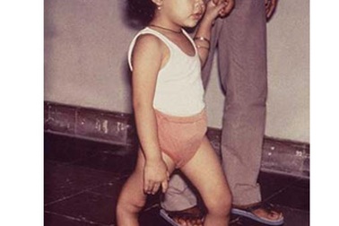 Bệnh bại liệt: Những điều đừng quên! 