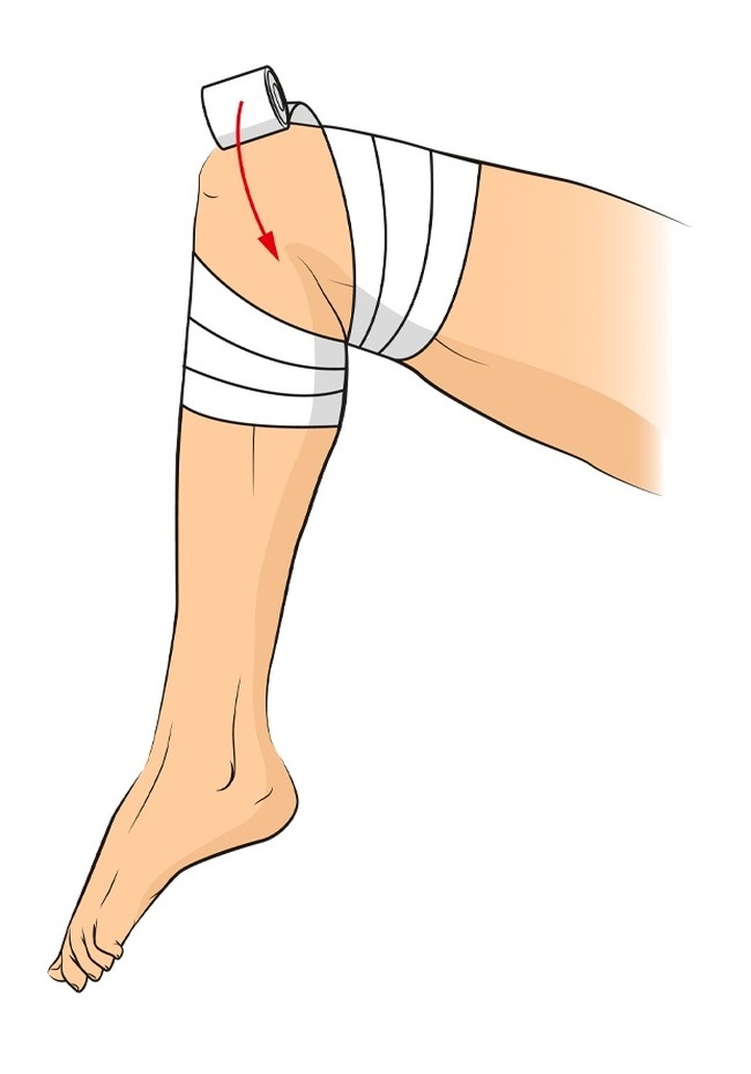 Trong trường hợp đầu gối bị thương, cách băng bó trên sẽ rất hữu ích, giúp cố định phần khớp. Bạn có thể dùng băng cuộn mềm cho loại vết thường này.