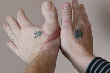 Dùng ngón chân cái để “thế” ngón tay cái