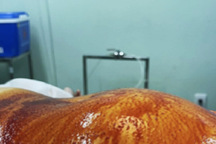 TPHCM: Bé gái có khối u quái khổng lồ ở bụng nhưng tưởng "ăn nhiều nên mập"