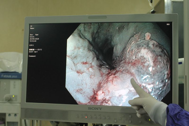 Nhờ hóc thịt ngan, người đàn ông phát hiện kịp thời ung thư thực quản