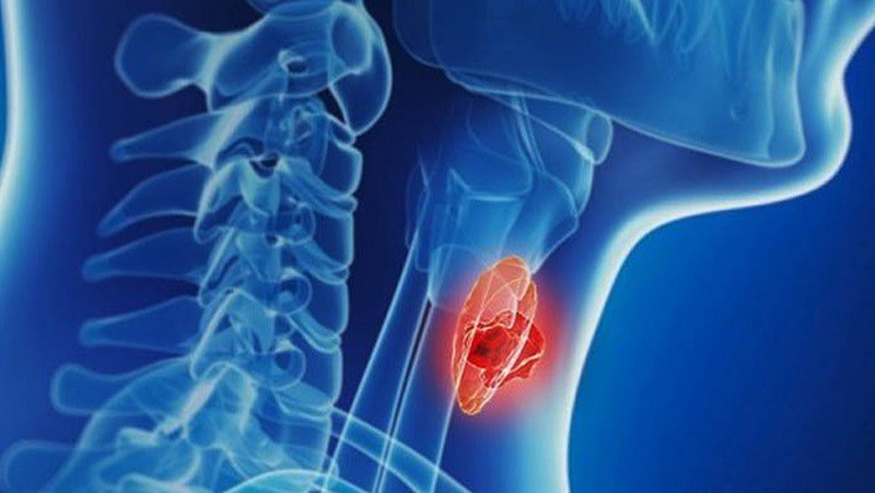 Dấu hiệu ung thư tuyến giáp giai đoạn đầu - 1