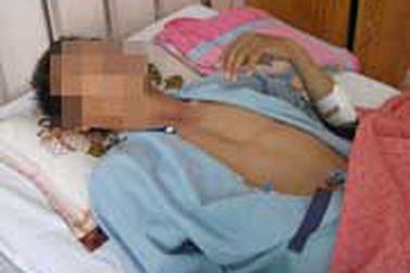 Một thanh niên bị đâm bằng kéo có máu nhiễm HIV