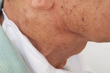 Khó thở, suy kiệt vì từ chối chỉ định điều trị ung thư hạ họng