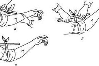 Tự garo - Thủ thuật y khoa dễ gây tai biến!