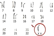 Kỳ lạ, cô gái 24 tuổi vẫn chưa dậy thì vì "lỗi ngẫu nhiên" của cơ thể