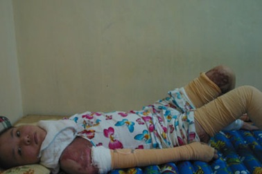 Tiếp thêm nghị lực cho cô sinh viên bị bỏng toàn thân