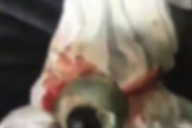 Say rượu vấp ngã, nam thanh niên rơi cả nhãn cầu ra ngoài