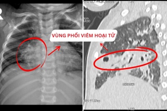 Bé gái 2 tuổi viêm phổi hoại tử sau 6 ngày ho, sốt
