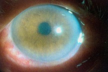 Cấp cứu nhiều người bỏng mắt vì đèn hồ cá, keo dán 502