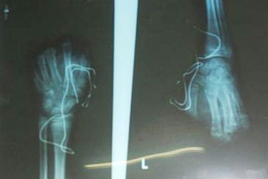 Cụt 5 đầu ngón tay vì nghịch máy mài dao