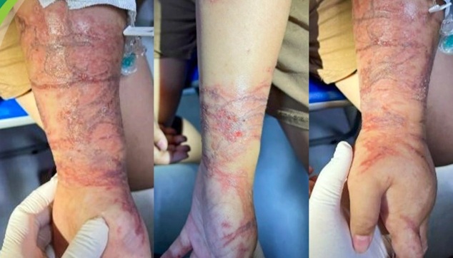 Vòng tay ôm sứa biển trong suốt, bé gái bị bỏng rát chằng chịt 2 cẳng tay - 1
