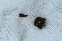 Người đàn ông đi nhiều bệnh viện, chịu khổ 8 năm trời sau khi... bị sặc