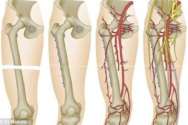 Trường hợp đầu tiên trên thế giới được ghép 2 chân