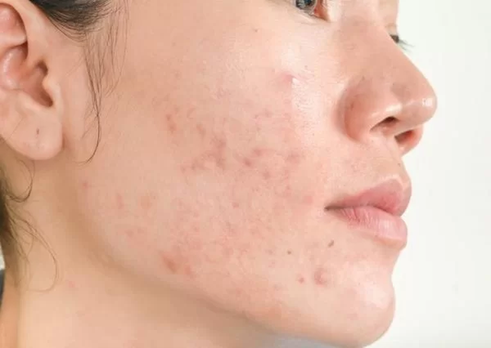 Decumar - 6 năm đồng hành cùng giới trẻ, tạm biệt nỗi lo thâm mụn - 1 Decumar - 6 năm đồng hành cùng giới trẻ, tạm biệt nỗi lo thâm mụn - 1