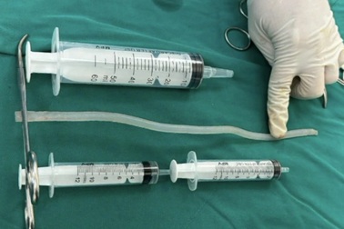 TPHCM: Chàng trai lâm nguy sau khi nhét thanh keo silicon 20cm vào vùng kín