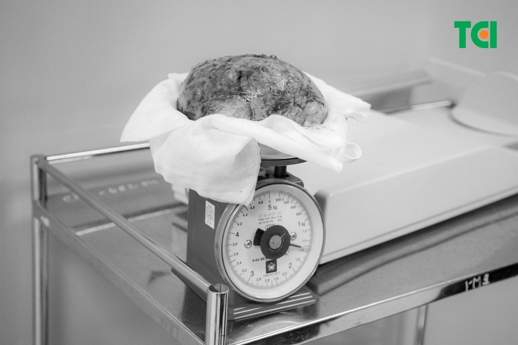 Bảo toàn thiên chức làm mẹ cho bệnh nhân có khối u xơ nặng 1,5kg - 3 Bảo toàn thiên chức làm mẹ cho bệnh nhân có khối u xơ nặng 1,5kg - 3
