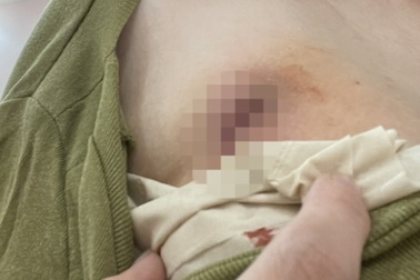 Vụ hỏng ngực sau khi tiêm "tế bào gốc": Cơ sở Manhattan có hành vi đối phó