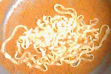 Kinh hoàng con sán xơ mít dài 10 mét nằm trong ruột