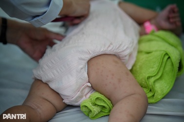 Sở Y tế TPHCM cảnh báo tác nhân gây bệnh truyền nhiễm quay trở lại