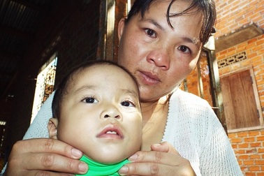 Bé 2 tuổi nguy kịch trước bệnh tim bẩm sinh phức tạp