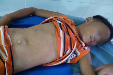 Hy hữu chuyện học sinh lớp 3 bị té dập gan