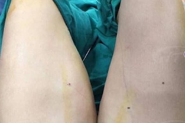 Nam bệnh nhân áp xe nặng sau hút mỡ vùng đùi