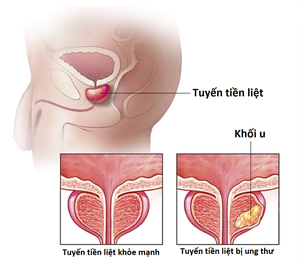 Phương pháp 2 trong 1: Vừa tiêu diệt ung thư vừa phục hồi thương tổn - 1