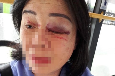 Công an điều tra vụ nữ tiếp viên xe buýt bị đánh bầm mắt