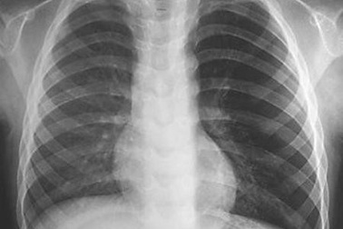 Thở ra tiếng sáo, ai dè cậu bé mắc kẹt còi trong cổ họng