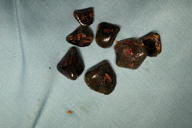 Cứu sống bệnh nhân bị sỏi mật biến chứng, nhiễm trùng nặng