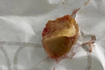 Ăn bún giò, cụ bà 67 tuổi bị xương lợn dài 1,5 cm lọt vào phế quản