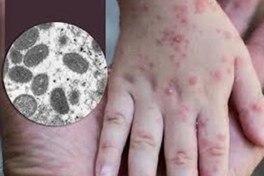 Bất ngờ ca nghi mắc bệnh đậu mùa khỉ ở Đà Nẵng: Là bệnh tay chân miệng