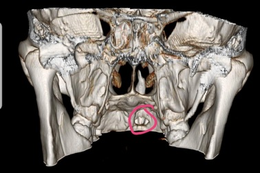 Hy hữu: Răng mọc ngầm chọc thủng hốc mũi