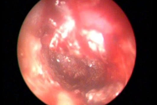 TPHCM: Ghi nhận hàng chục ca chấn thương nặng, vỡ xương khi ngoáy tai - 2