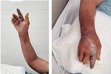 Người đàn ông sốt nóng lạnh, tay sưng vù chỉ vì vết thương nhỏ do chó cắn