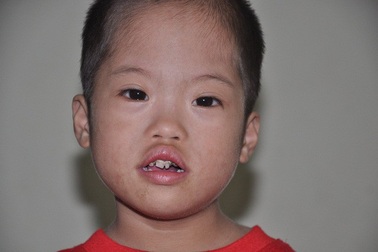 Bệnh viện Nhi Trung ương hỗ trợ toàn bộ chi phí phẫu thuật cho bé Hồng Quyền