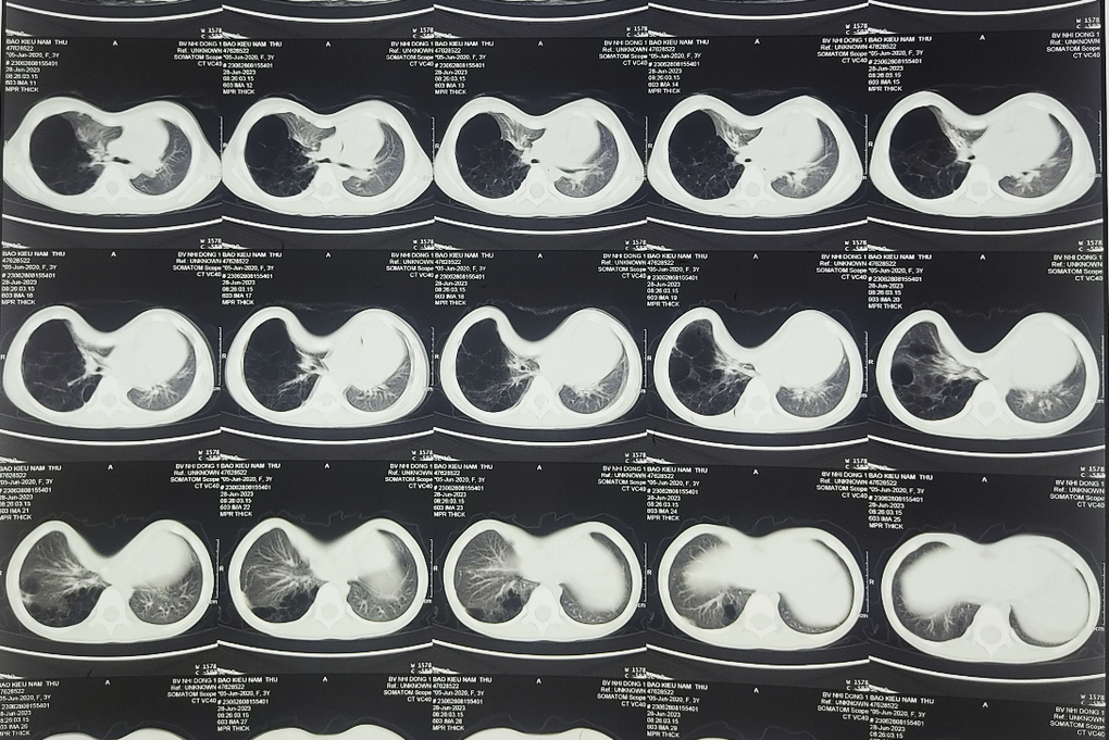 Hy hữu bé gái 3 tuổi có lồng ngực lõm như chiếc chén, đặt vừa quả trứng vịt - 2 Hy hữu bé gái 3 tuổi có lồng ngực lõm như chiếc chén, đặt vừa quả trứng vịt - 2