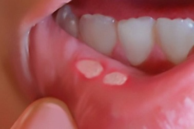 Bí kíp chống viêm, trị nhiệt miệng tại nhà