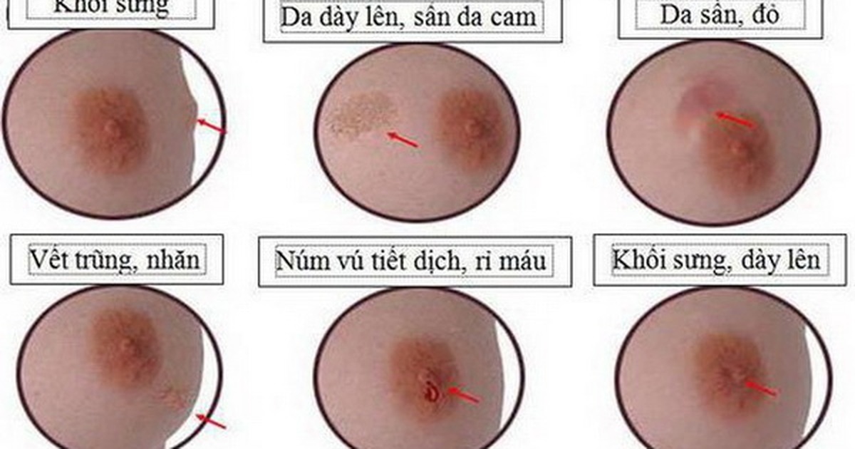 4. Các yếu tố ảnh hưởng đến tình trạng tiết dịch núm vú